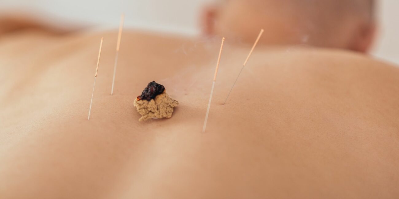 moxibustion avec traitement d'acupuncture