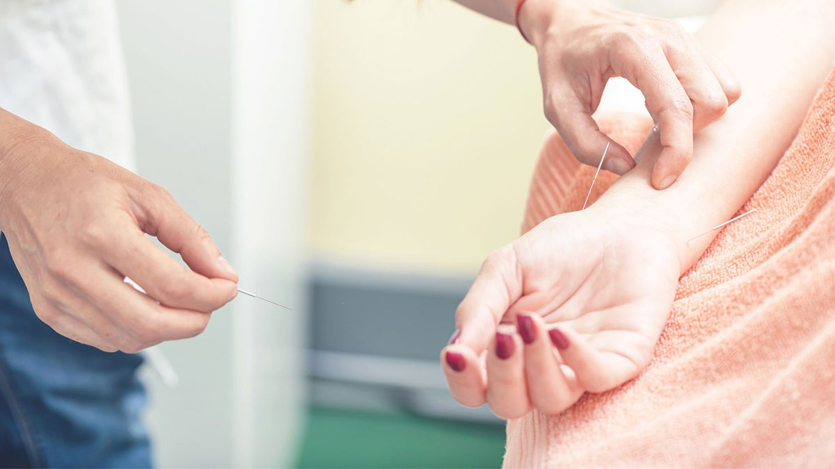 personne plaçant des aiguilles d'acupuncture pour la grossesse