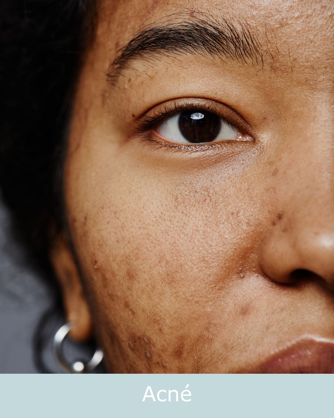 acné