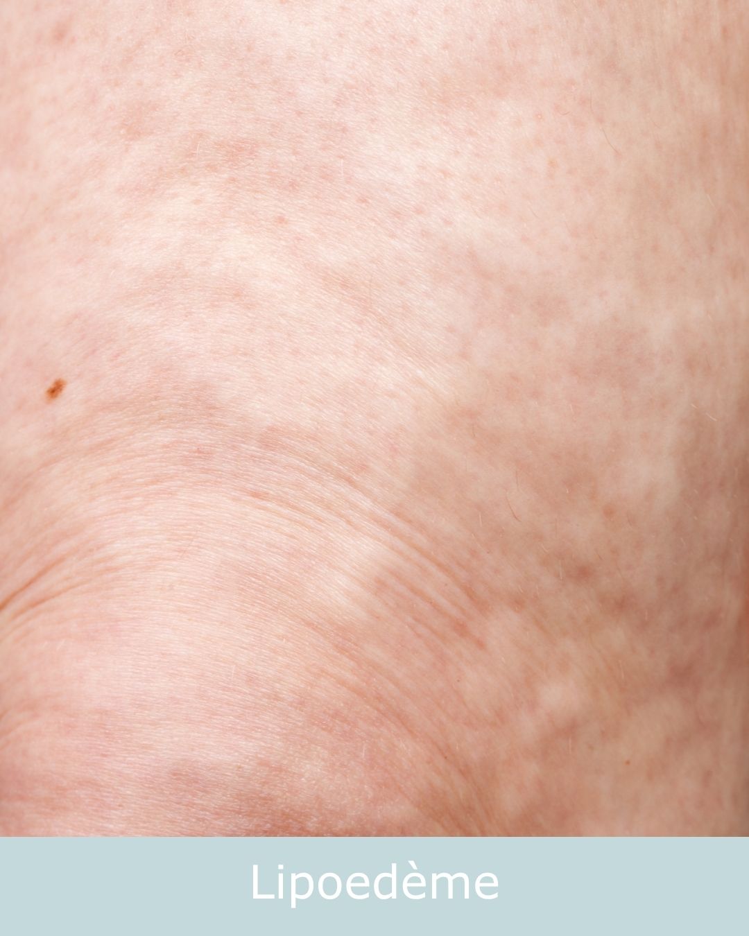 lipoedeme