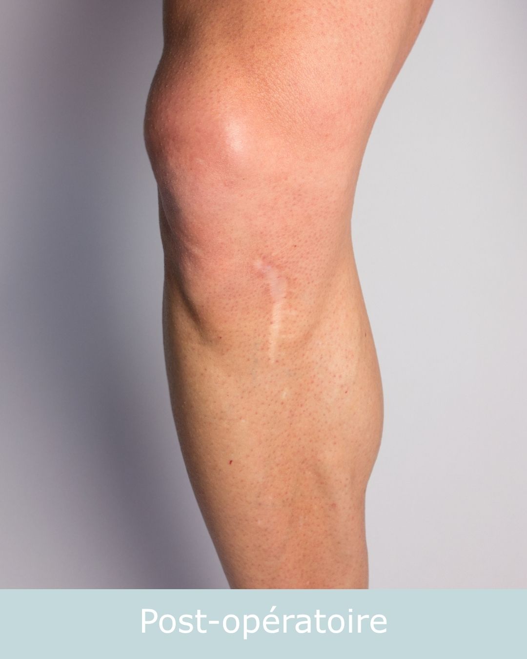 post-opératoire