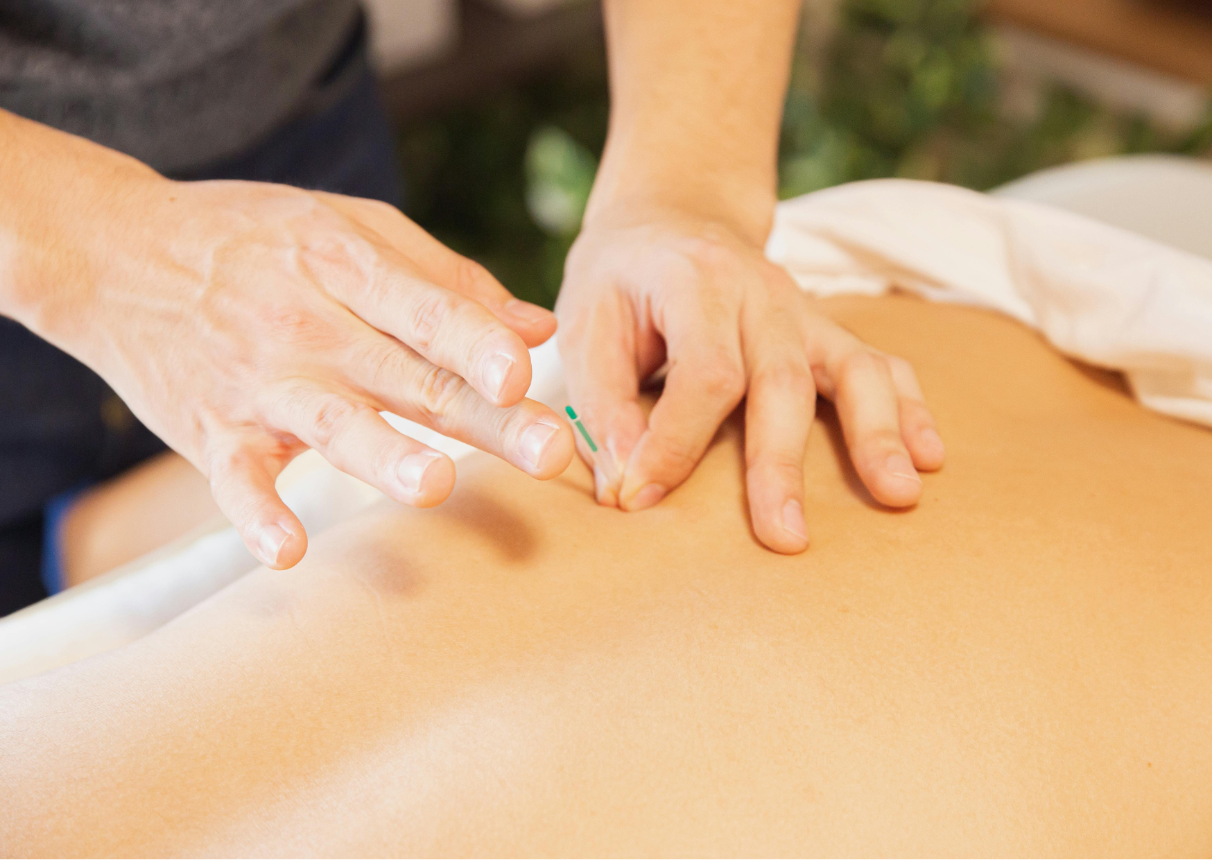 acupuncture acupuncture