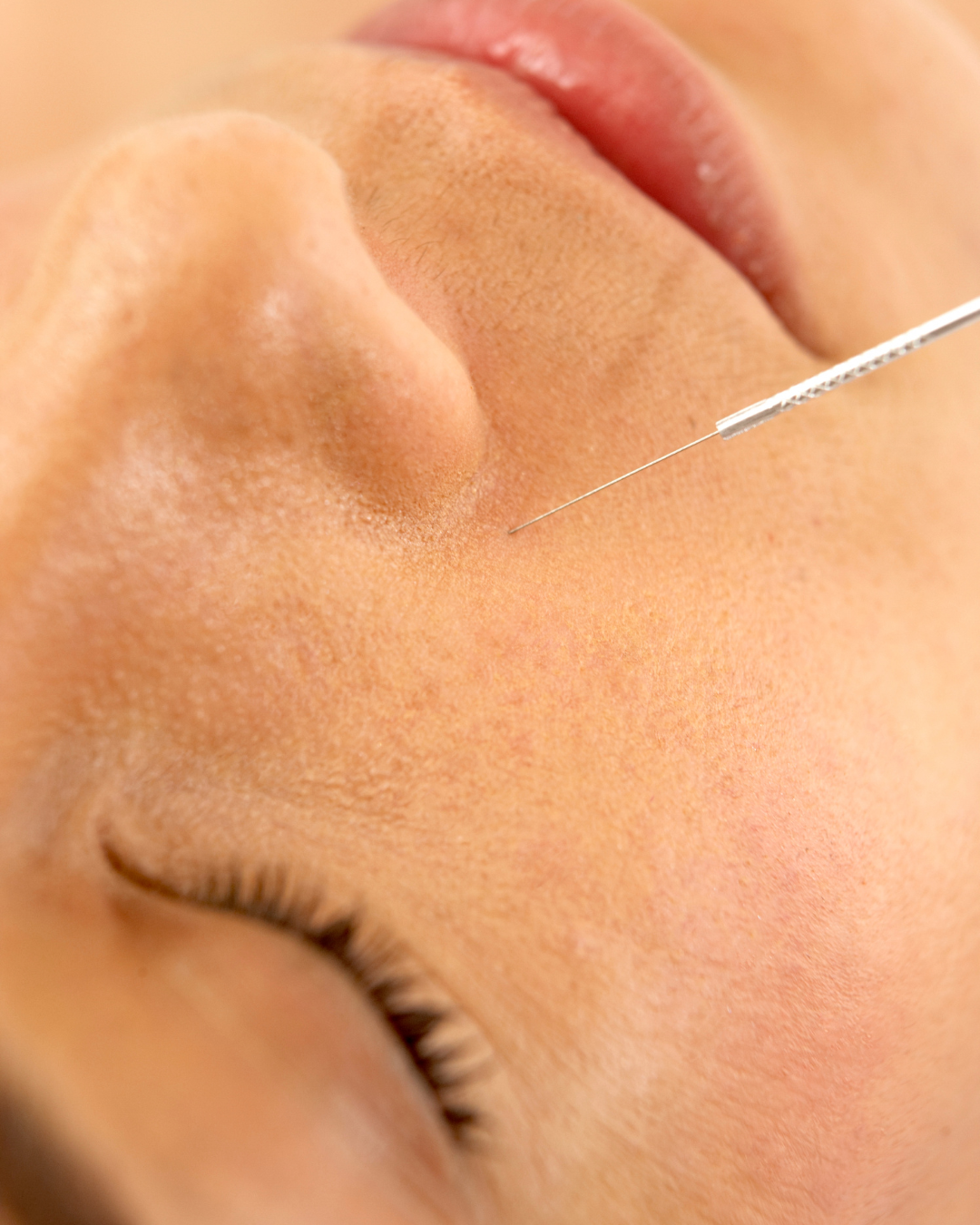 acupuncture esthétique