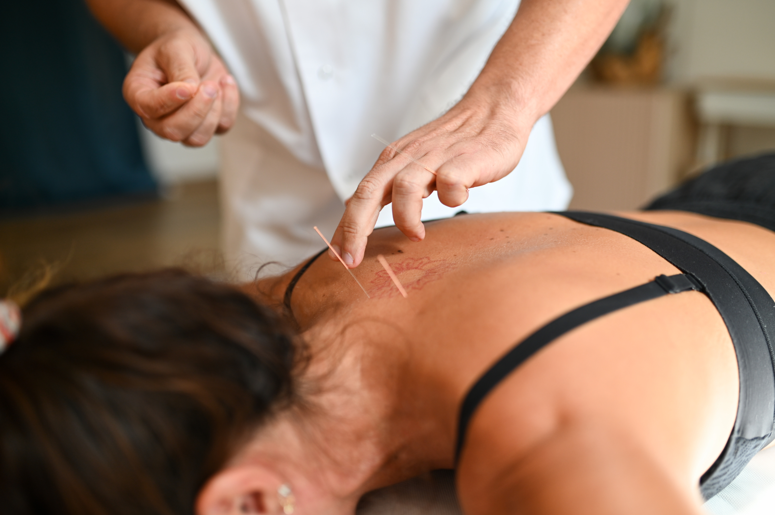 acupuncture